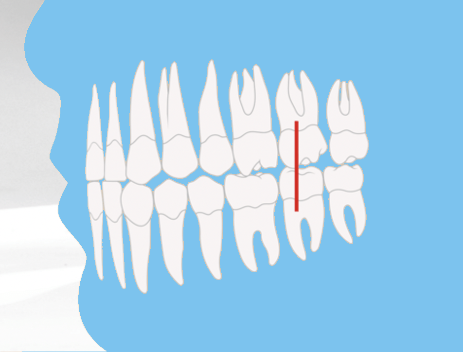 Darstellung der Angle-Klasse I Zahnstellung, kieferorthopädische Standardreferenz für Zahnfehlstellungen