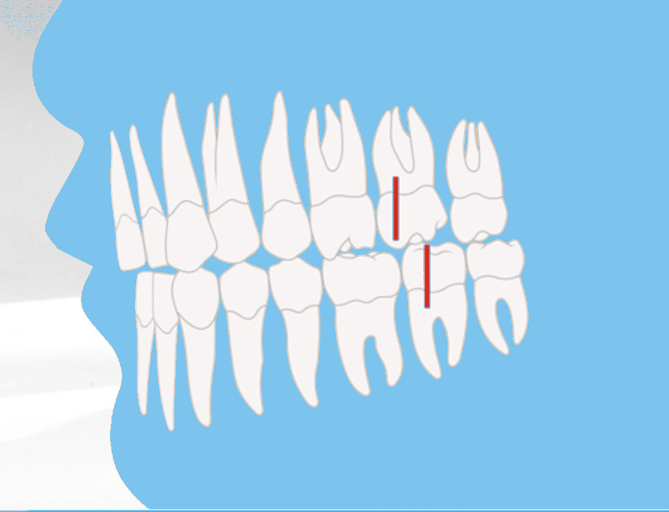 Zahnfehlstellung der Angle-Klasse II/1 mit vorstehenden Schneidezähnen, kieferorthopädische Illustration