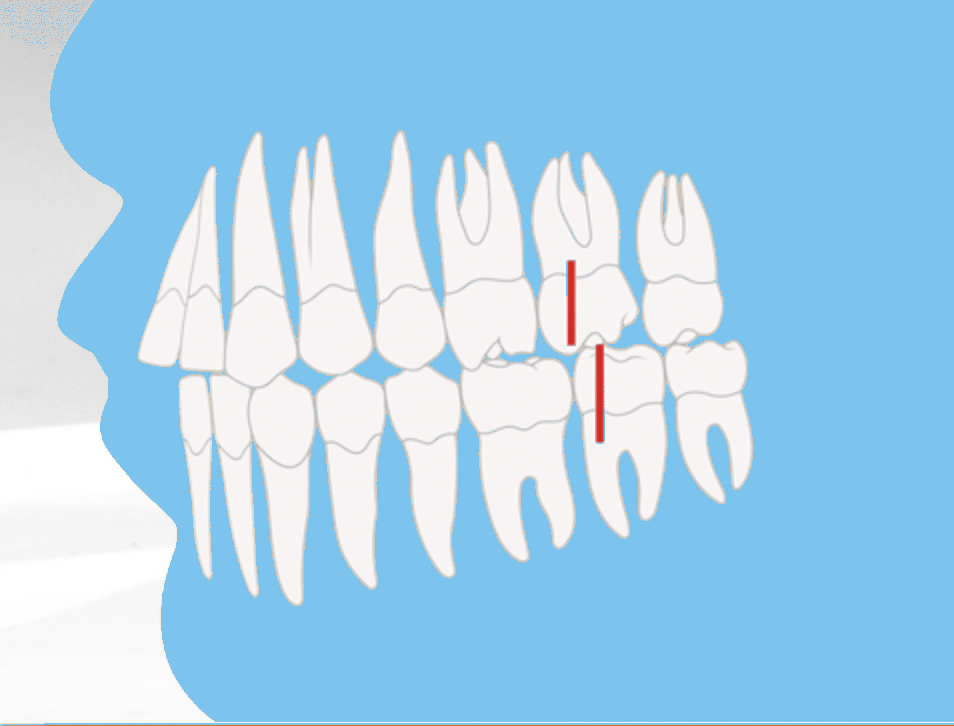 Zahnfehlstellung der Angle-Klasse II/1 mit vorstehenden Schneidezähnen, kieferorthopädische Illustration