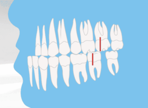 Zahnfehlstellung Angle-Klasse III mit vorstehendem Unterkiefer (Progenie), kieferorthopädische Abbildung