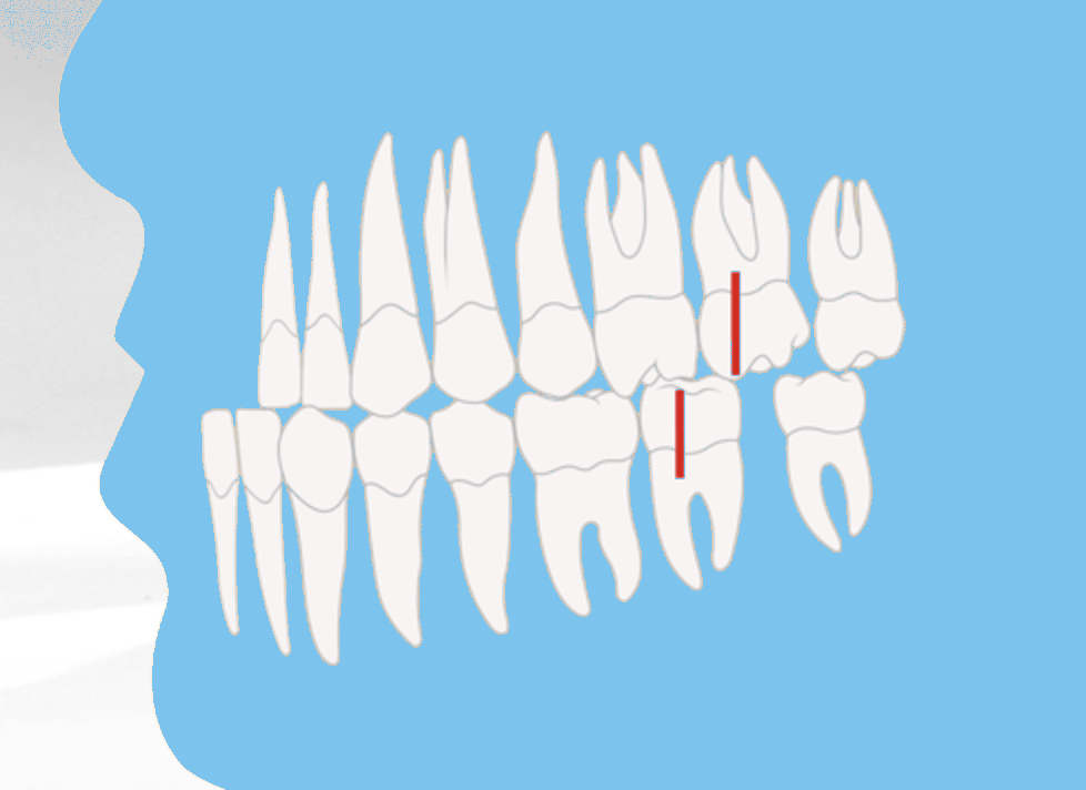 Zahnfehlstellung Angle-Klasse III mit vorstehendem Unterkiefer (Progenie), kieferorthopädische Abbildung