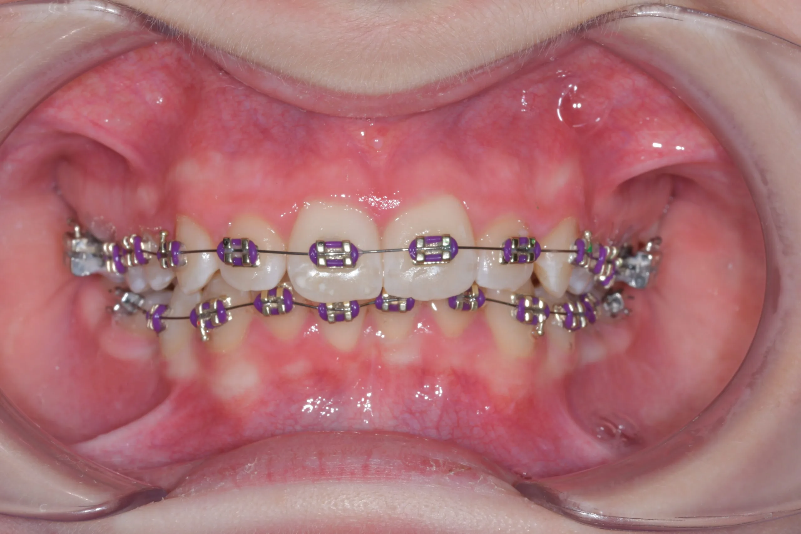 Frontalansicht von Ober- und Unterkiefer mit fester Zahnspange: ICONIX Bracketsystem von American Orthodontics mit violetten Ligaturen